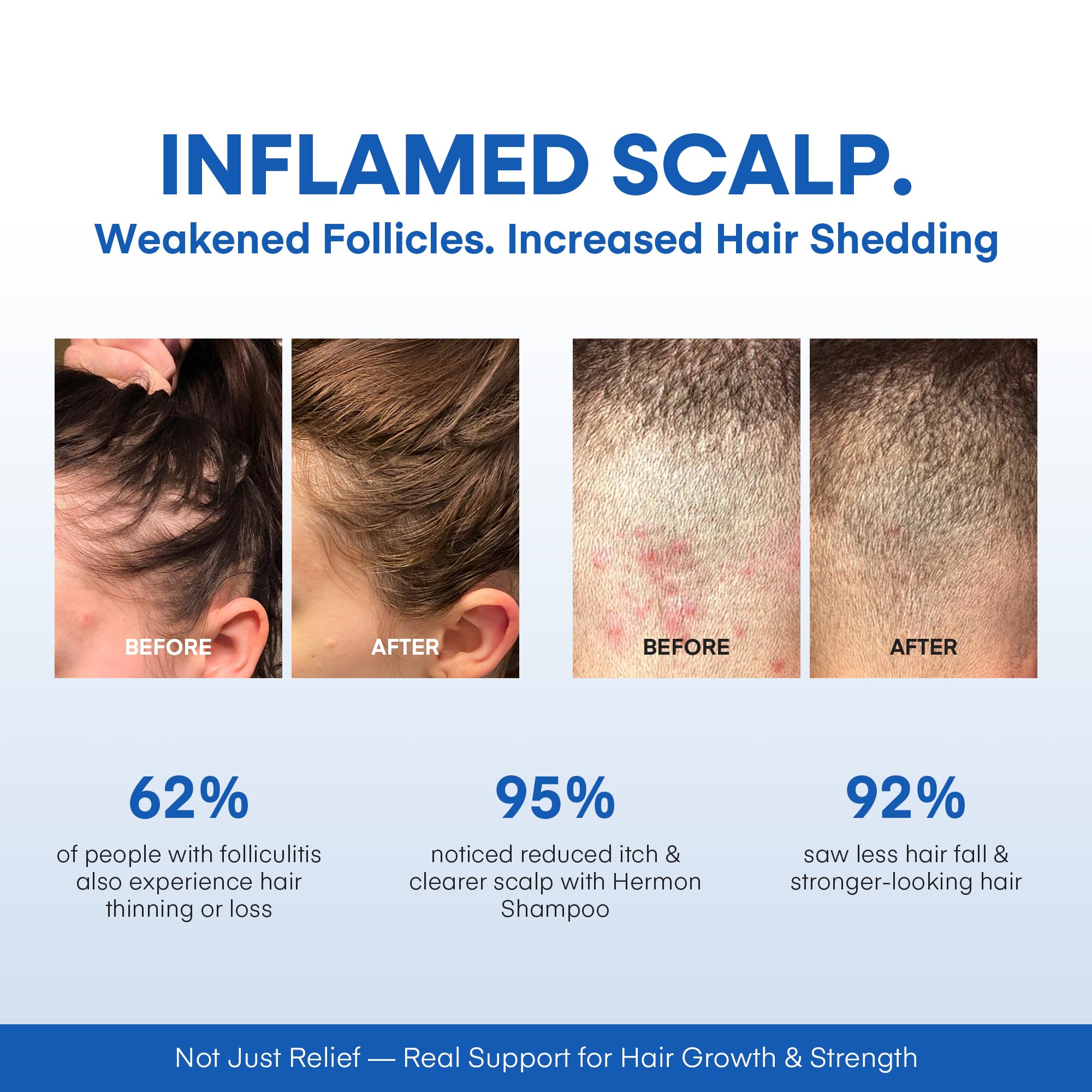 Hermon champú biotina, fortalece raíces y cabello saludable.