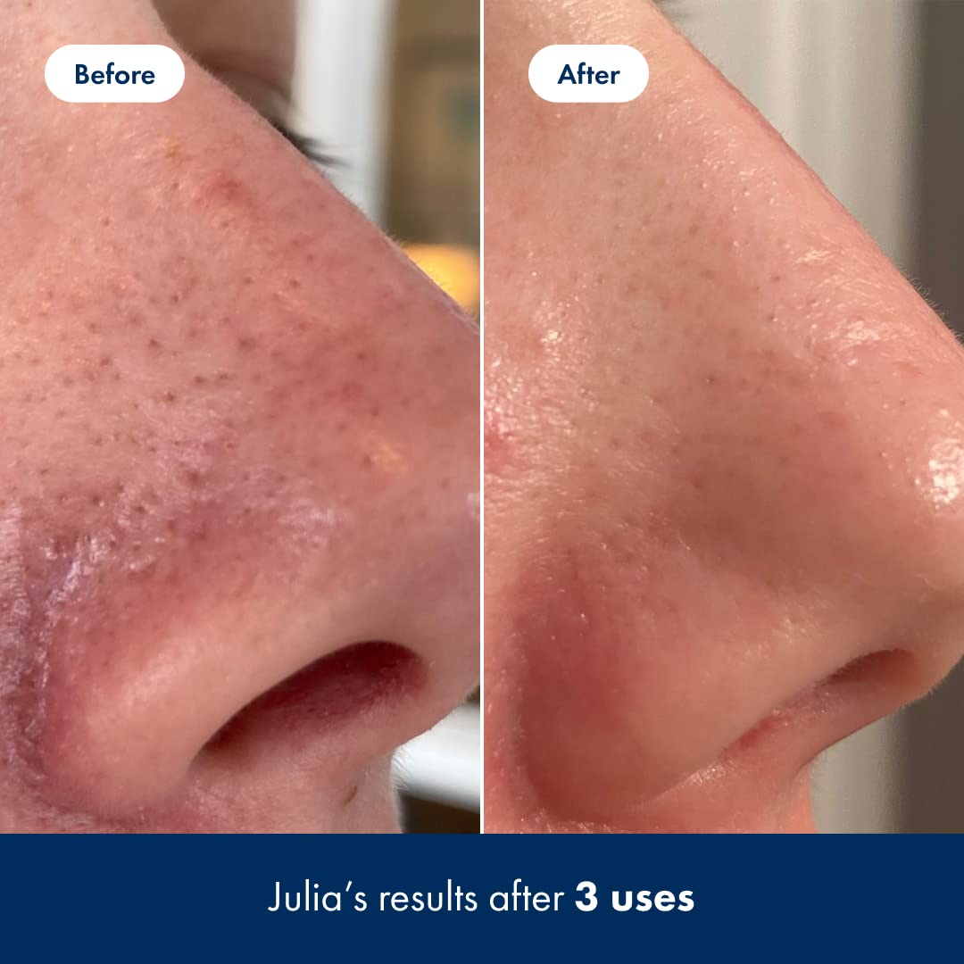 Hero Cosmetics Pore Release peut être utilisé sur la zone T.