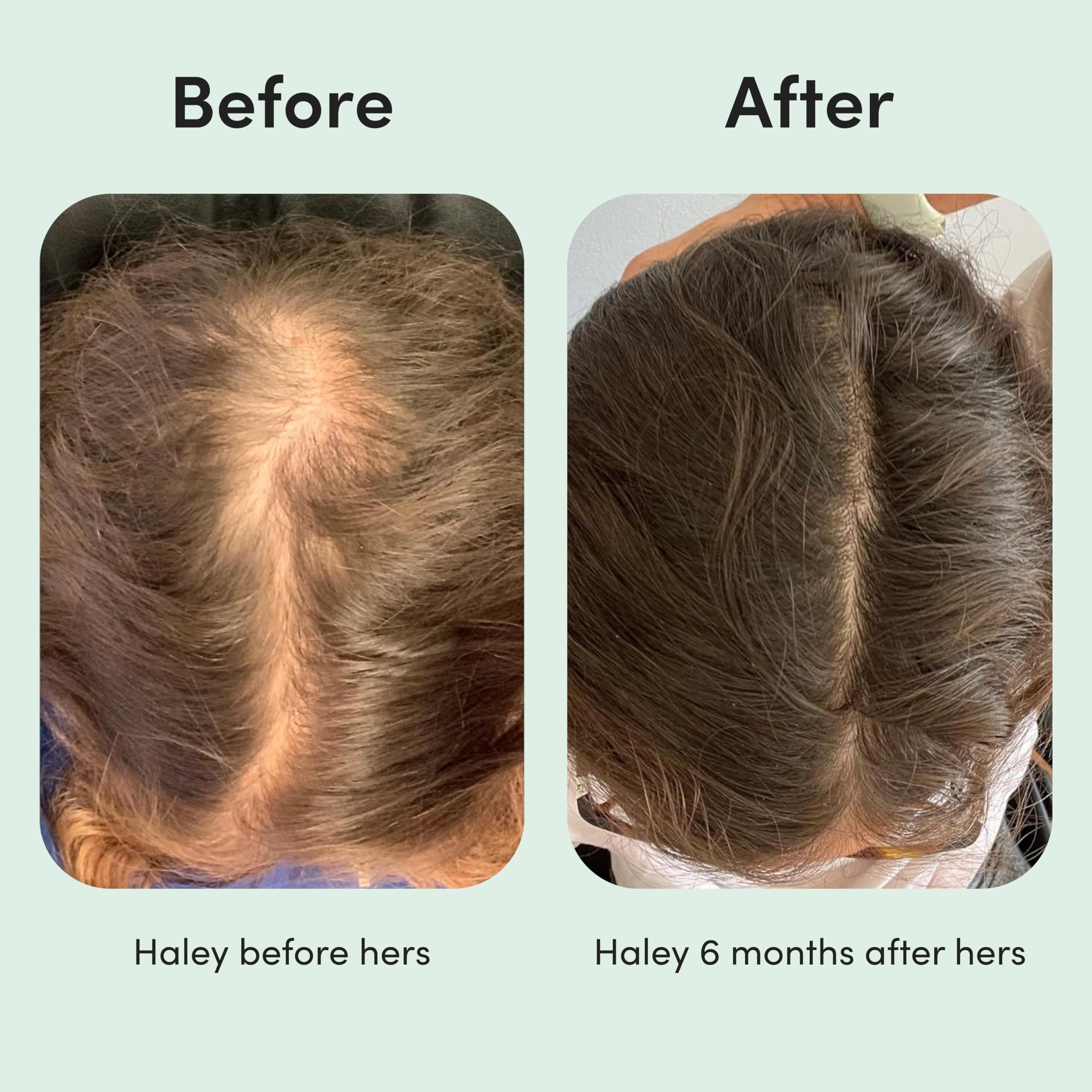 Hers Hair Regrowth, diseño fácil, cuidado capilar constante