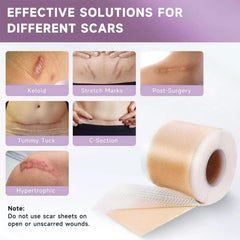 HN LAYXL: cinta silicona abdominoplastia, se adapta a cicatriz extensa.