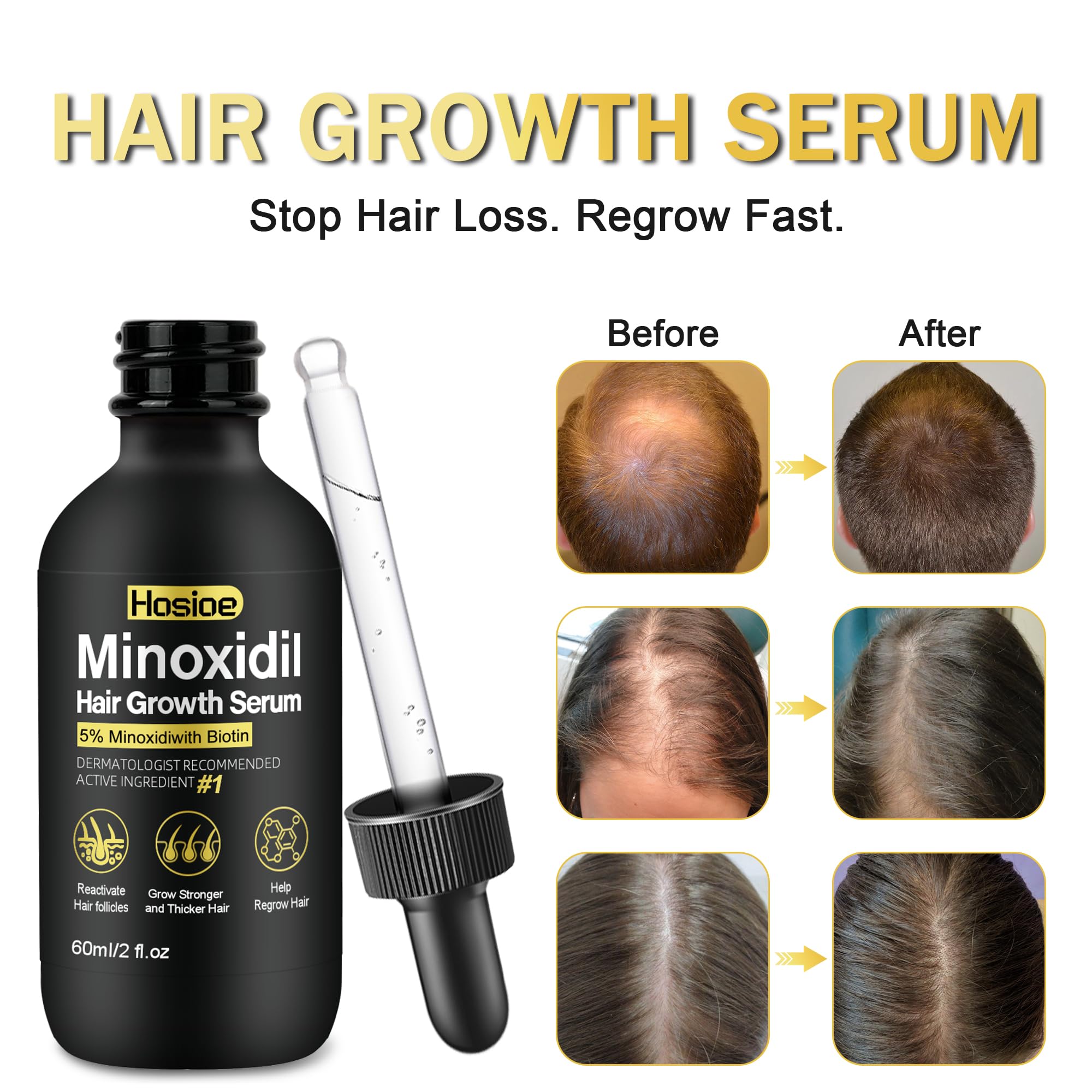 Aplicador preciso de Hosioe Minoxidil para aplicación limpia en el cuero cabelludo.