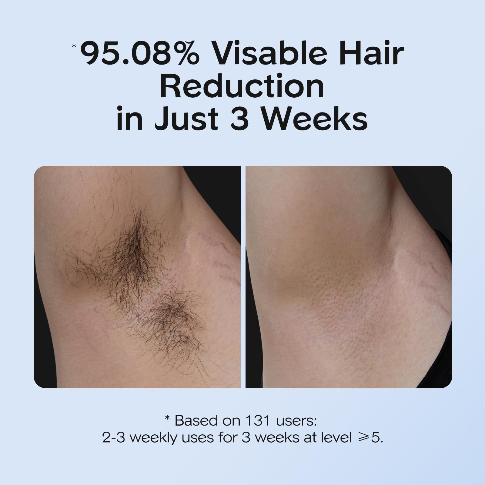 INNZA IPL 9-niveles-energia: ajuste para zonas grandes y sensibles.