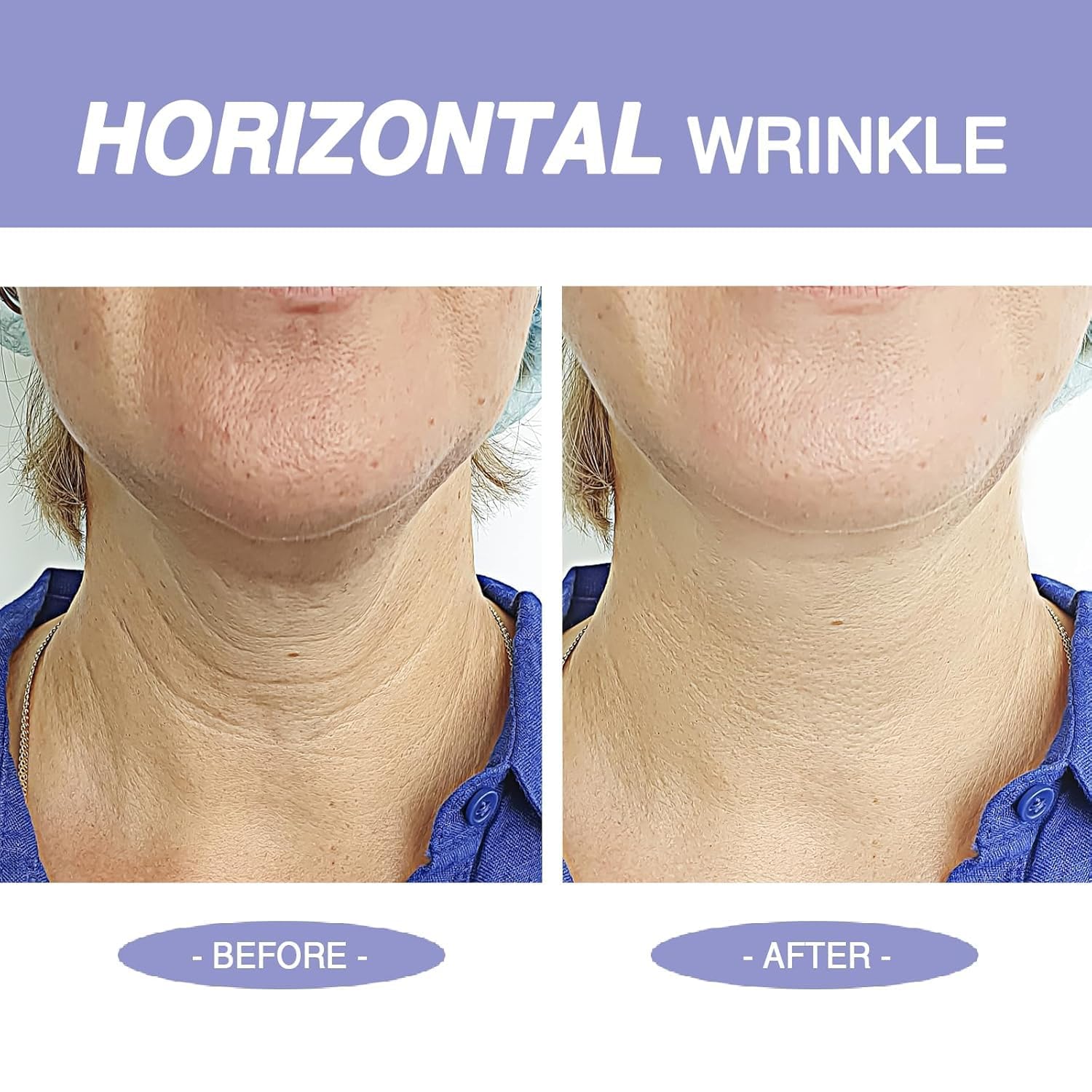 Irismistx crema cuello: fórmula con retinol y hialuronico para suavizar arrugas