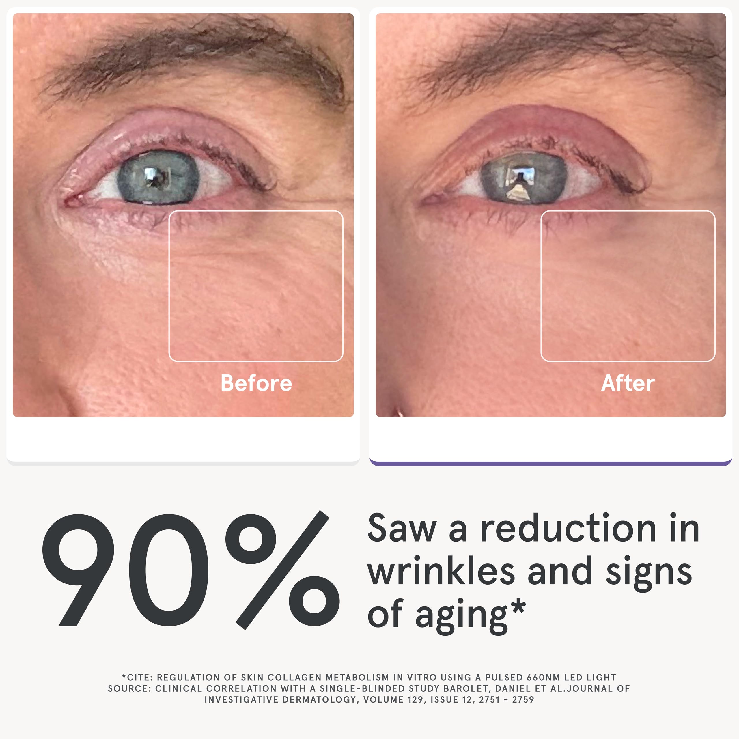 iRestore luz roja e infrarroja alrededor de los ojos para revitalizar la mirada.