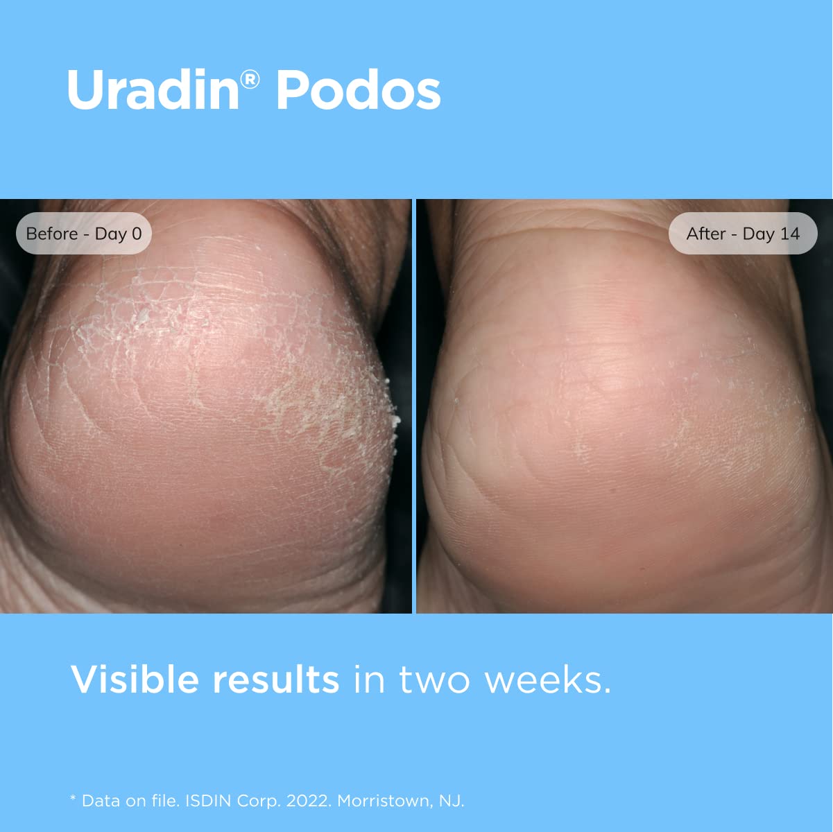 ISDIN Uradin Podos exfoliante suave para piel gruesa