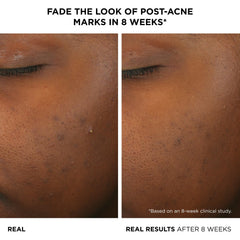 IT Cosmetics Bye Bye Breakout Serum - textura ligera para absorción rápida.