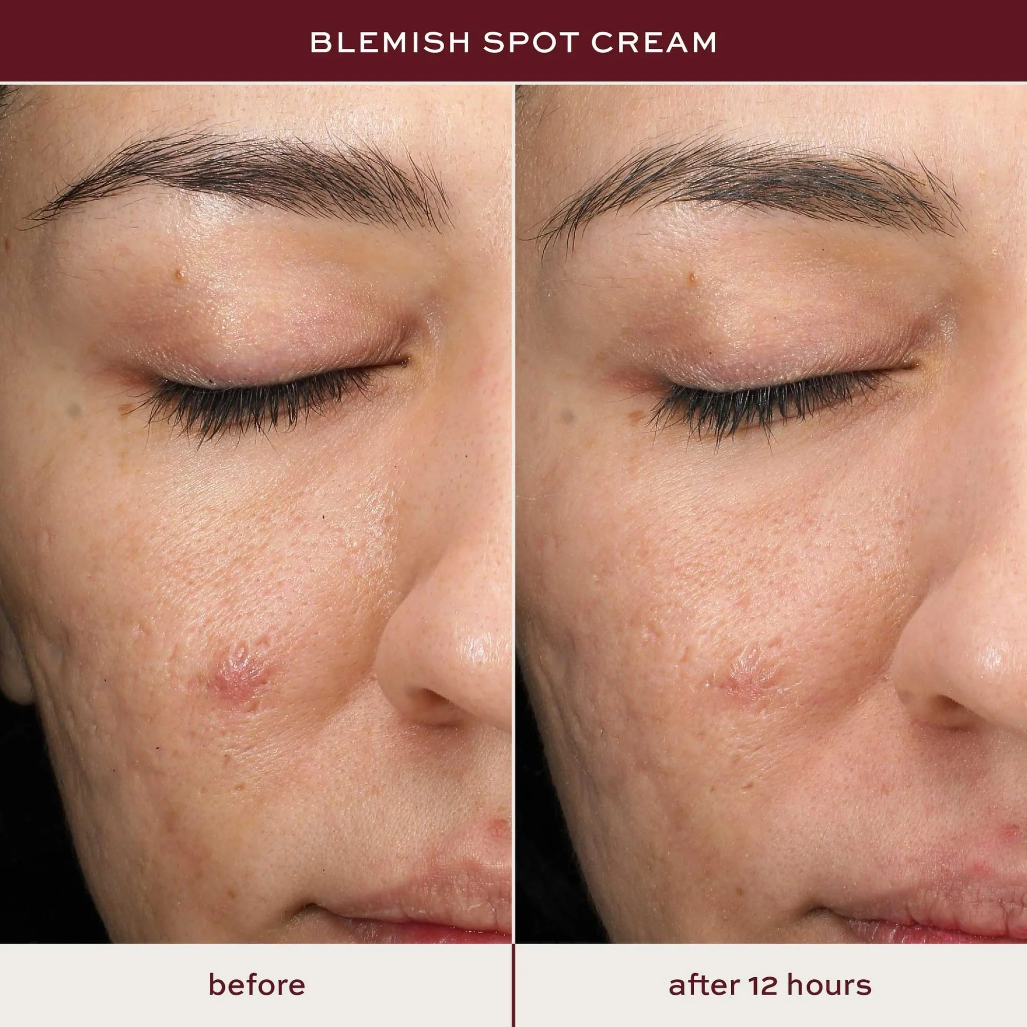 ITK Skincare uso seguro en rostro, espalda y cuerpo para puntos específicos
