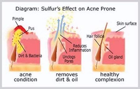 JOESOEF SKIN CARE Jabón de azufre para hongos en uñas, uso tópico.