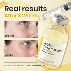 KOEC levantamiento contorno facial mejora elasticidad de la piel.