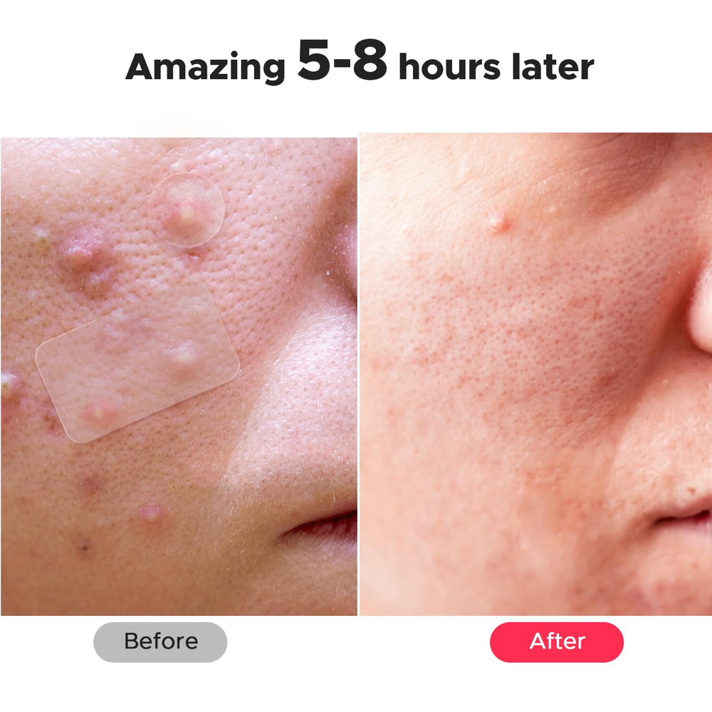 Parche LitBear para rostro, absorbe líquido y ayuda a aplanar imperfecciones.