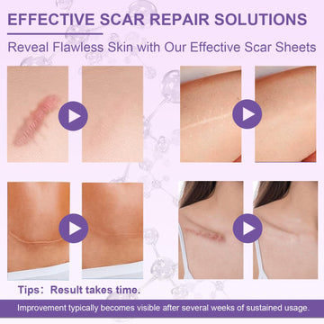 Luxefus parche de silicona para cicatriz facial, protege la piel delicada.
