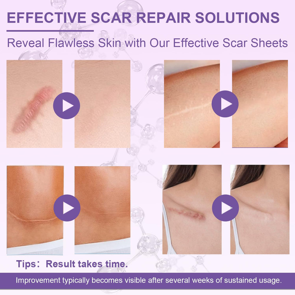 Luxefus parche de silicona para cicatriz facial, protege la piel delicada.