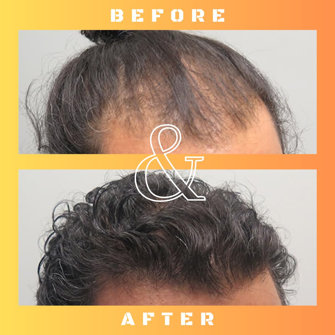 Mane Regain: crecimiento de cabello al usar RU58841 de forma regular.