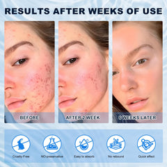 marianp crema ácido azelaico 10% reduce rojeces y enrojecimiento facial