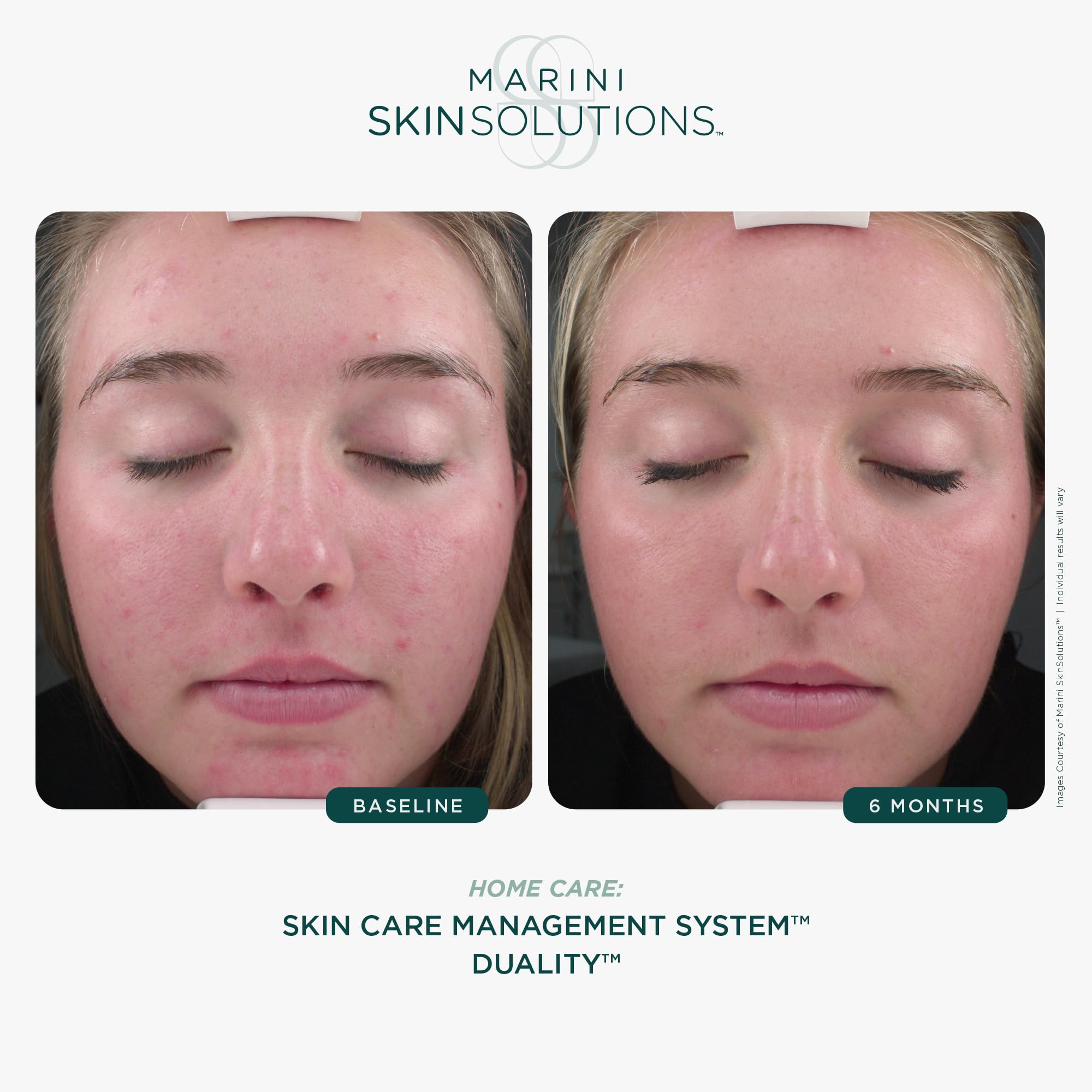 Marini SkinSolutions Duality, aplicación en la zona afectada para cobertura uniforme.