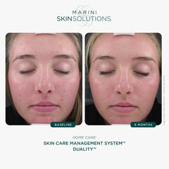 Marini SkinSolutions Duality, aplicación en la zona afectada para cobertura uniforme.