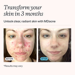 MDacne ingredientes naturales: vitamina E y té verde para hidratación