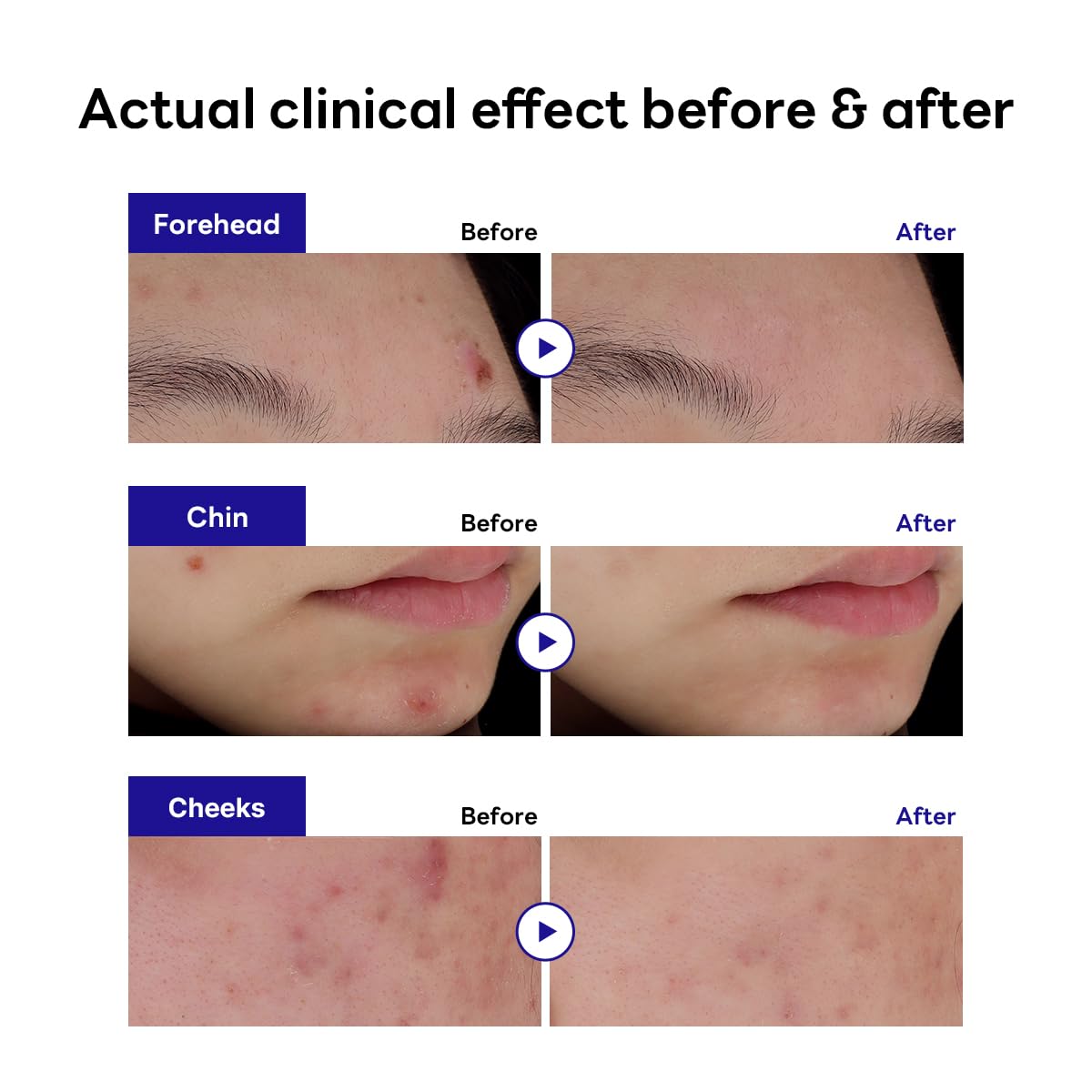 Textura hidrocoloide de Mediheal Derma Clear que absorbe el exudado