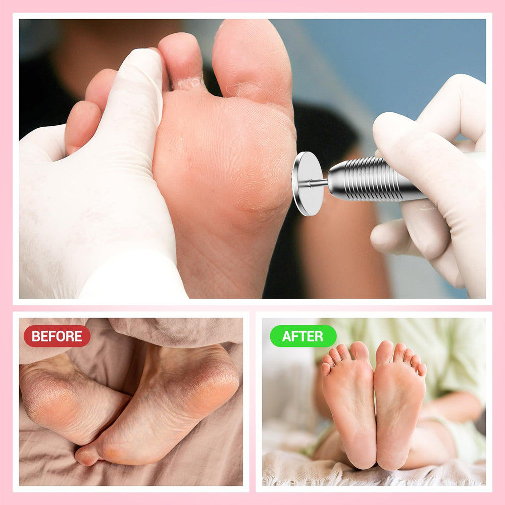 Uso en pies con MelodySusie para suavizar áreas ásperas