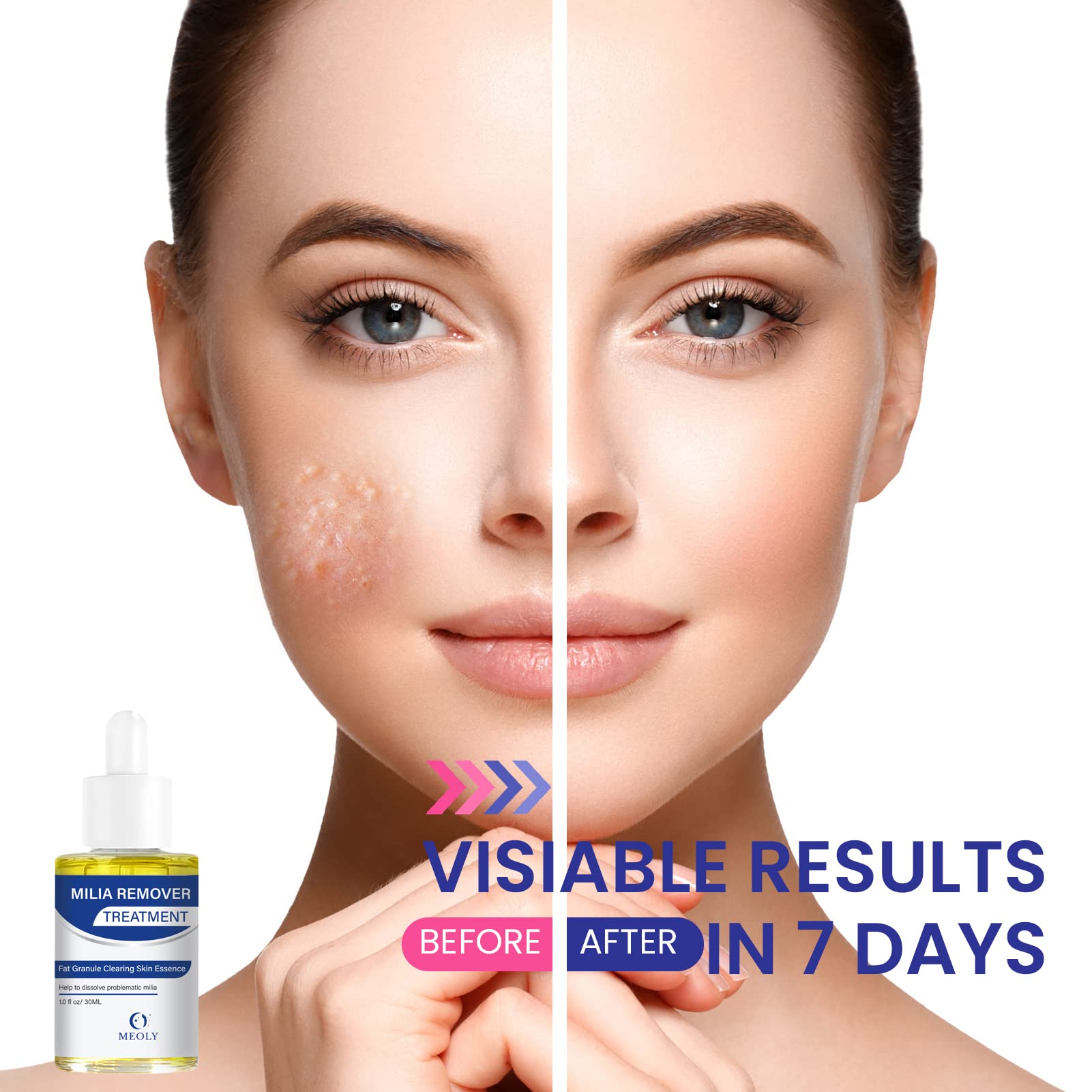 MEOLY Milia Remover, aplicación de tamaño guisante, absorción rápida.