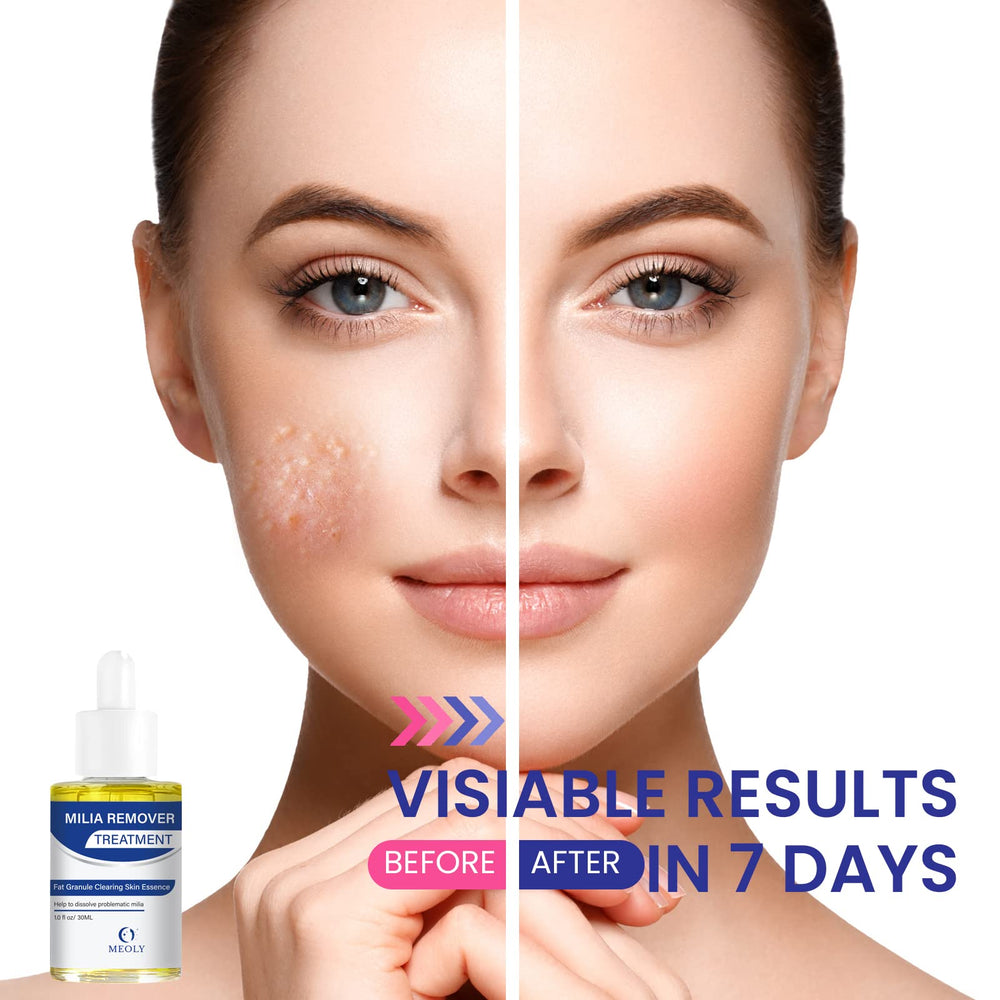 MEOLY Milia Remover, aplicación de tamaño guisante, absorción rápida.