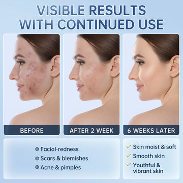 Mopayzer azelaic acid cream application on face to help redness