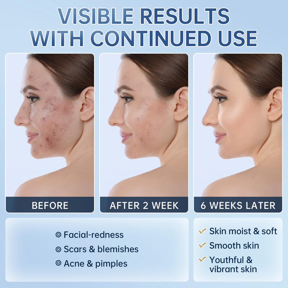 Mopayzer azelaic acid cream application on face to help redness
