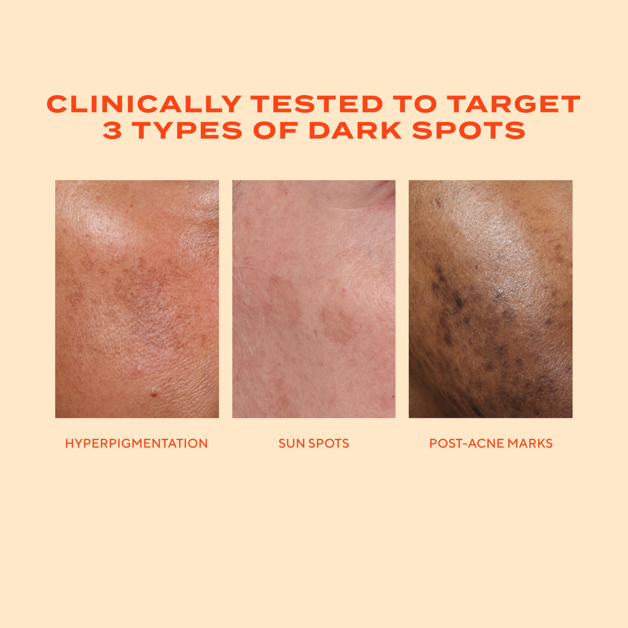 Comparatif avant-après Murad Rapid Dark Spot Serum montrant l’apparence des taches.