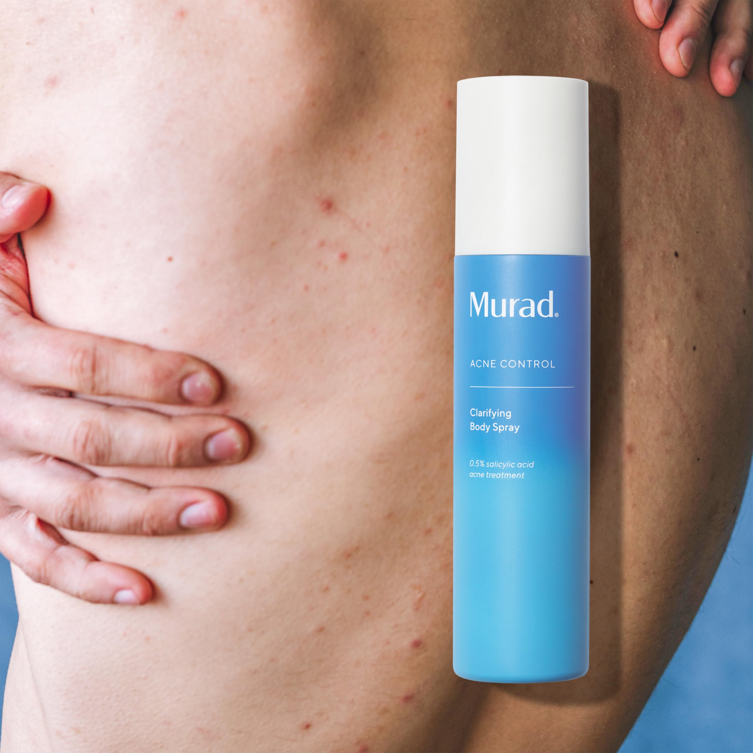 Murad atomizador corporal clarificante, tratamiento para espalda y pecho con brotes.