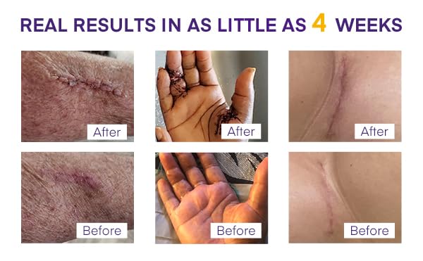 MURASAKI BEAUTY uso para quemaduras y cicatrices con gel de silicona.