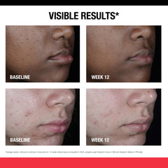 Neutrogena Retinol SA: ingrediente retinol SA que favorece la renovación suave.