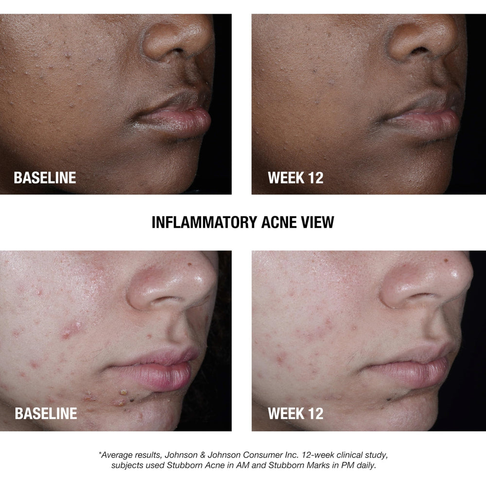 Neutrogena Stubborn Acne AM Treatment absorbed into skin with light, non-greasy finish.