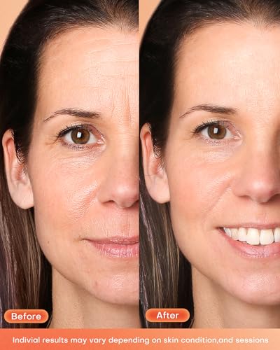 NEWKEY mascarilla facial con luz roja en uso mejora la apariencia de la piel.