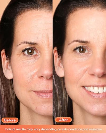 NEWKEY mascarilla facial con luz roja en uso mejora la apariencia de la piel.