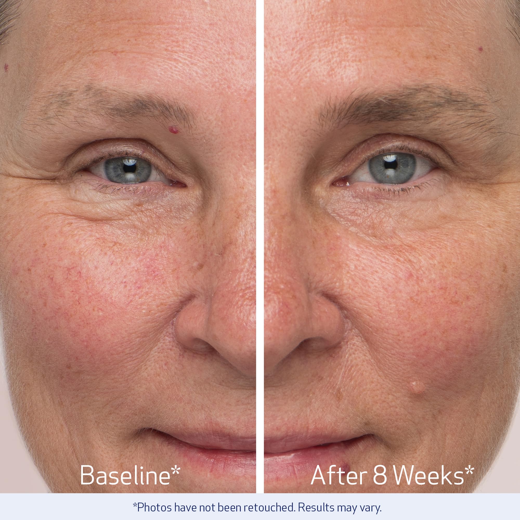Obagi Nu-Cil Serum mostró mejoras de densidad y volumen en participantes.