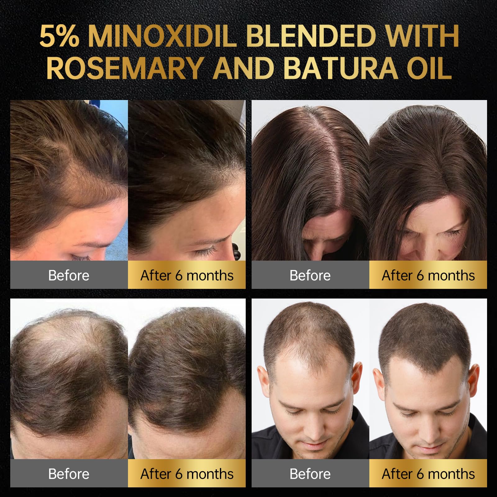 OCSINL Minoxidil aplicación masaje suave que llega a las raíces para nutrir el cabello.