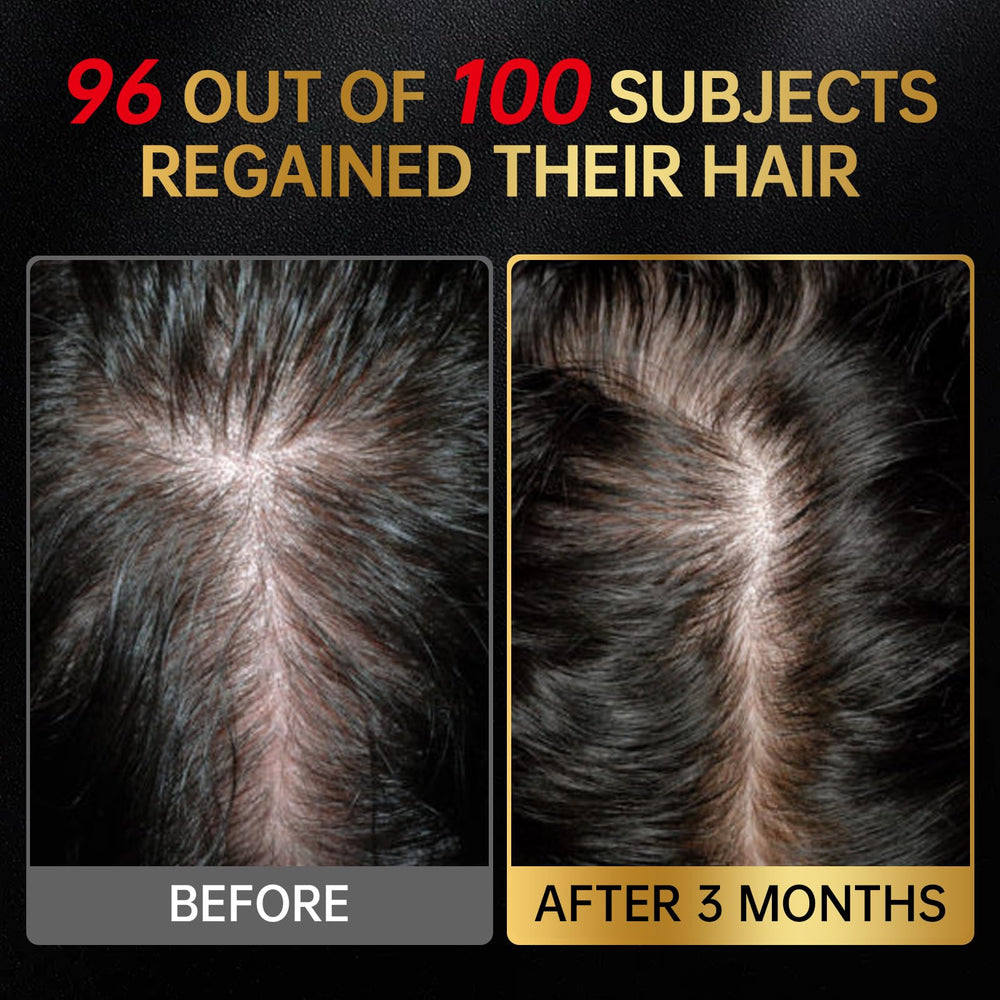 OCSINL Minoxidil ingredientes de romero y batana para cuero cabelludo sano.