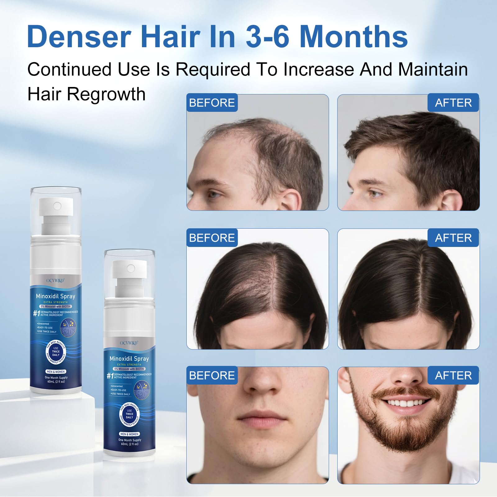 OCVWJKD Minoxidil flujo: aplicación suave con absorción rápida.