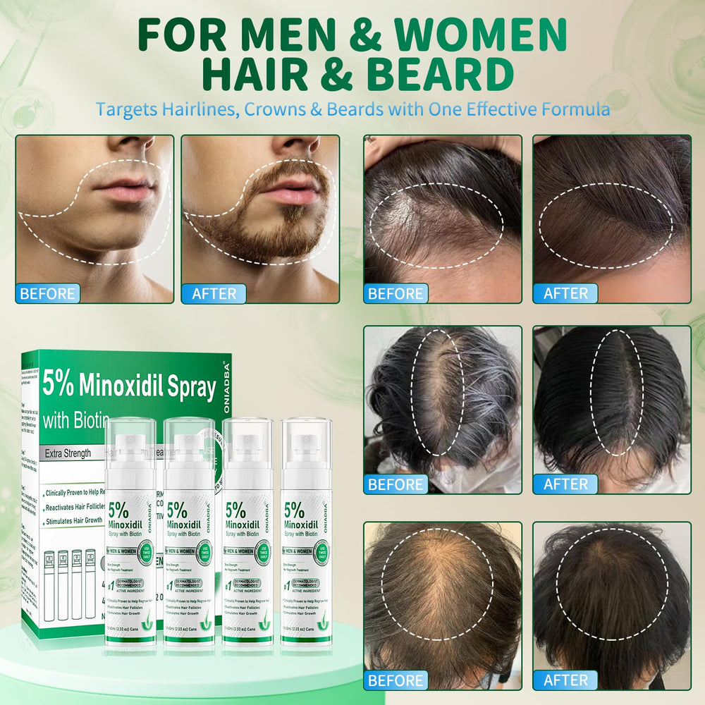 ONIADBA Minoxidil en cuero cabelludo para estimular crecimiento capilar.