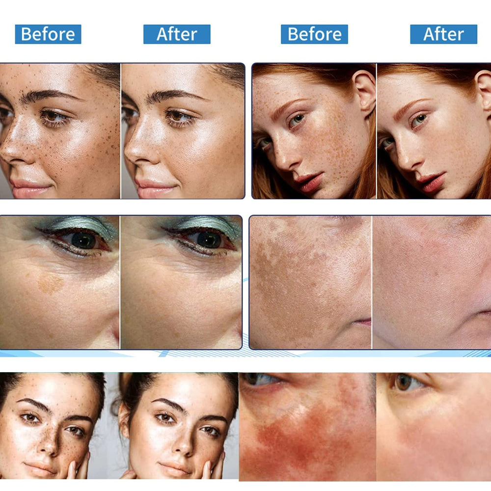 Paradise Emerald melasma reduccion, opción suave para rostro.