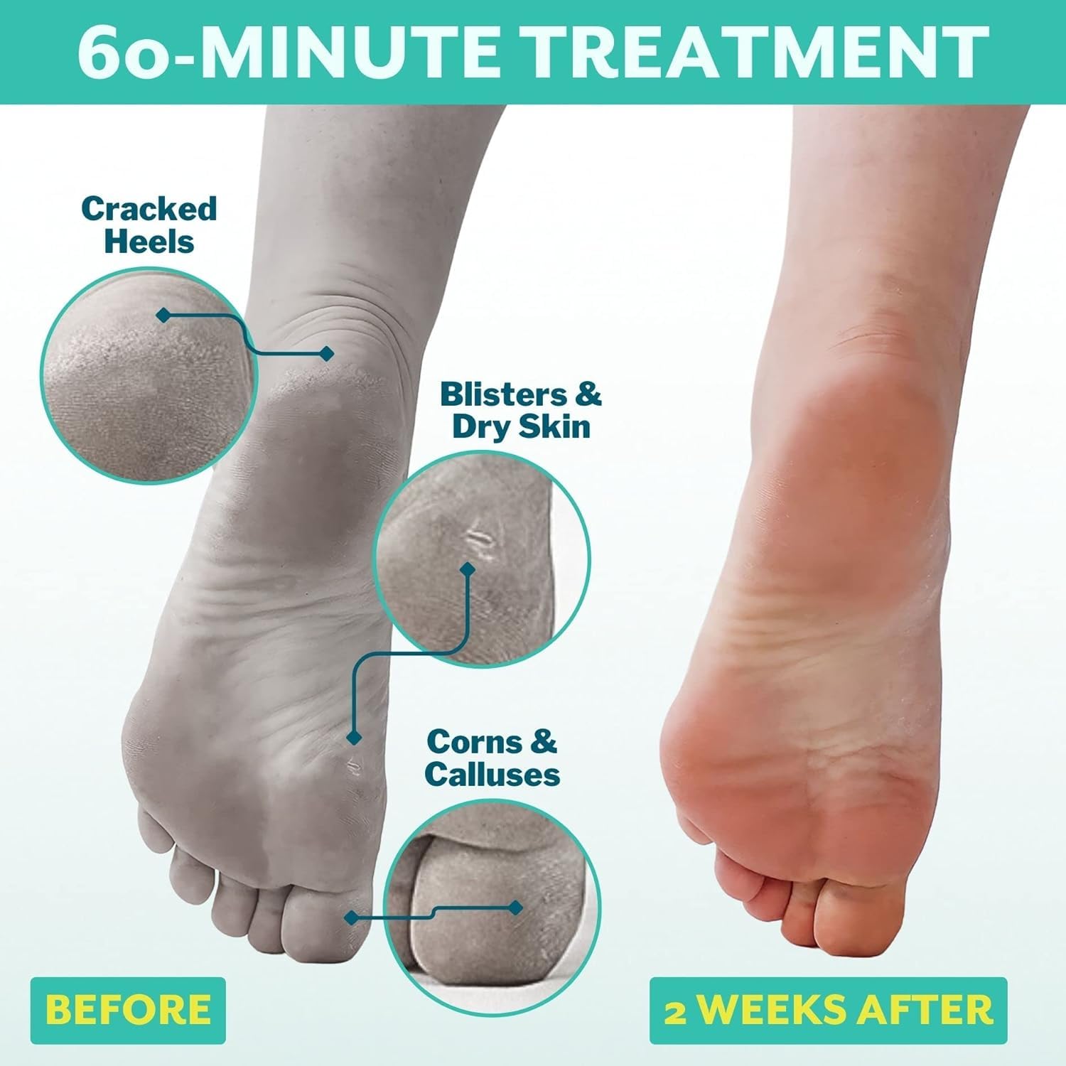 Patchology PoshPeel Pedi Cure, botas exfoliantes en acción para suavizar la piel de los pies