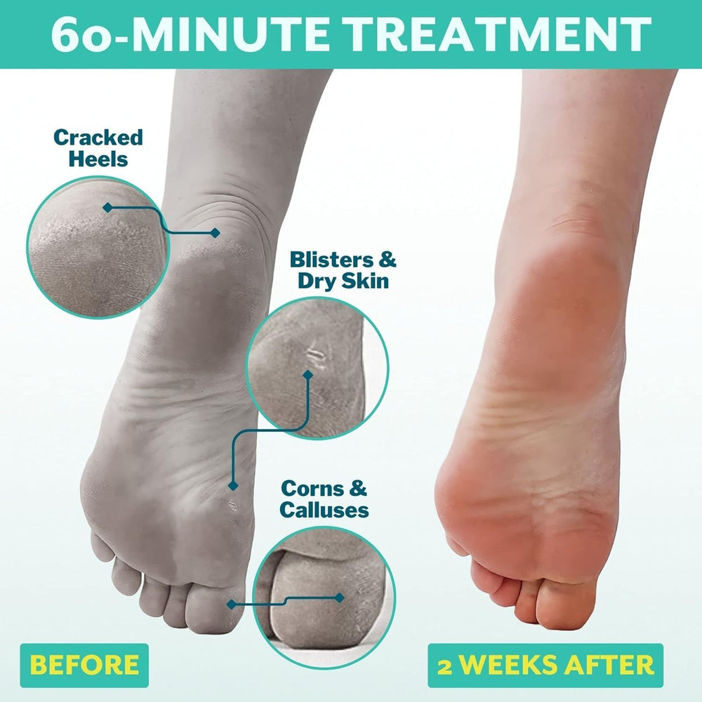 Patchology PoshPeel Pedi Cure, botas exfoliantes en acción para suavizar la piel de los pies