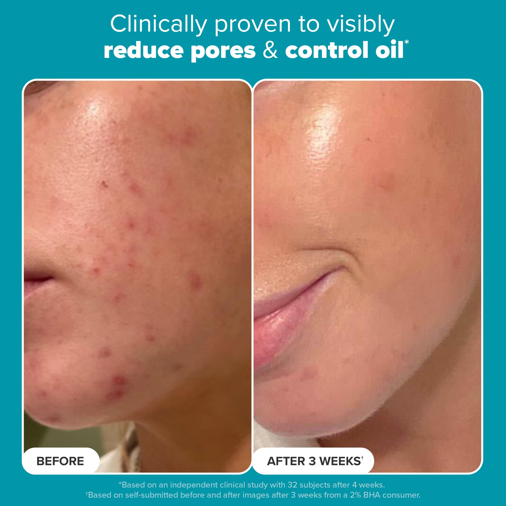 Paula's Choice Skin Perfecting 2% BHA, aplicación en mano para poros visiblemente limpios.