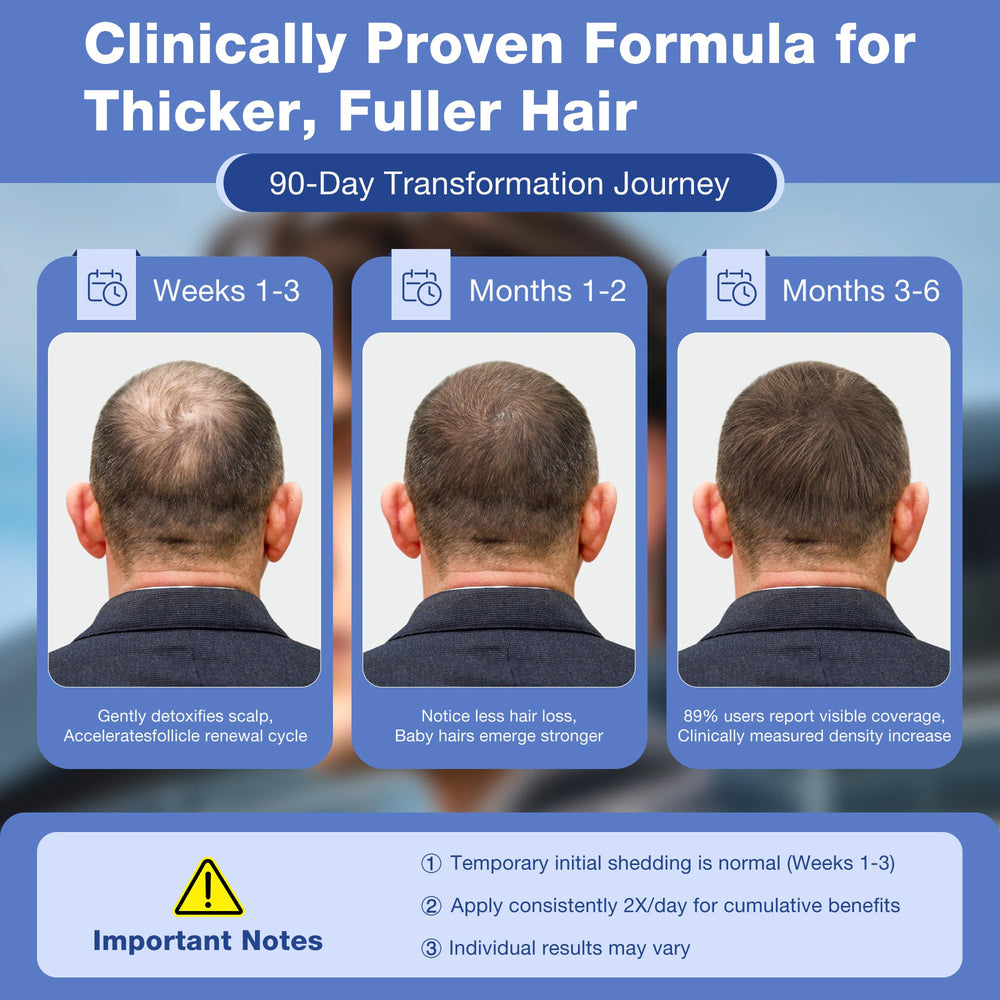 Pdam Minoxidil spray de aplicación fácil para cabello debilitado