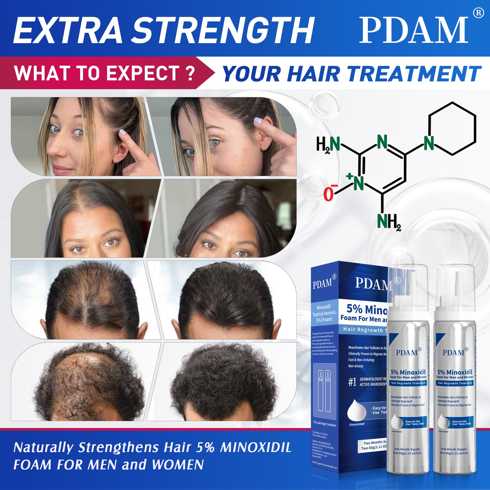 Pdam Minoxidil espuma, aplicación de espuma en cuero cabelludo para cabello más grueso.
