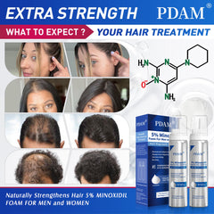 Pdam Minoxidil espuma, aplicación de espuma en cuero cabelludo para cabello más grueso.