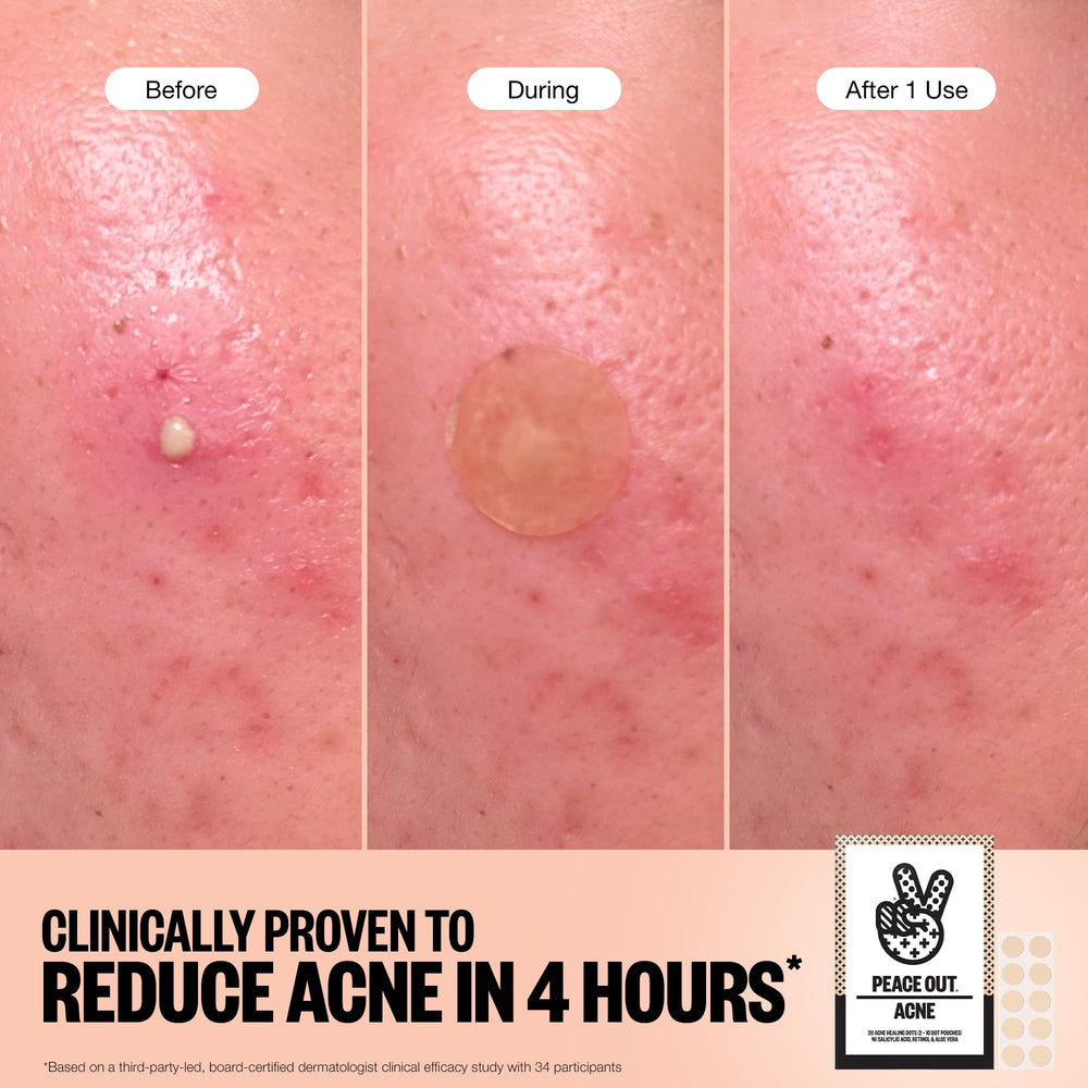 Parche Peace Out con retinol para mejorar la apariencia de imperfecciones.