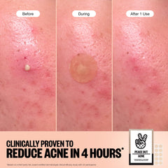 Parche Peace Out con retinol para mejorar la apariencia de imperfecciones.