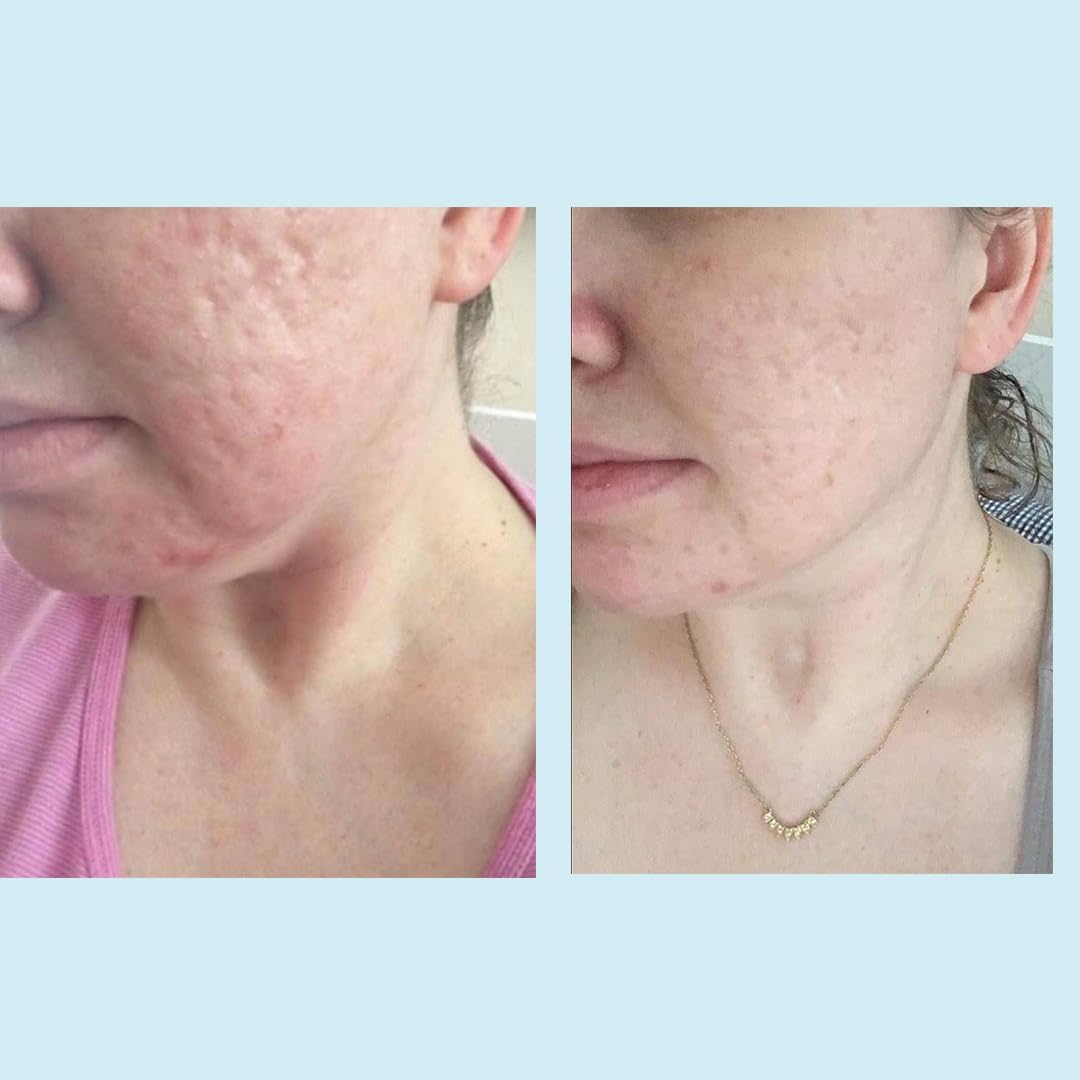 Perfect Image Glycolic 50% Gel Peel exfoliación regular para tez más clara