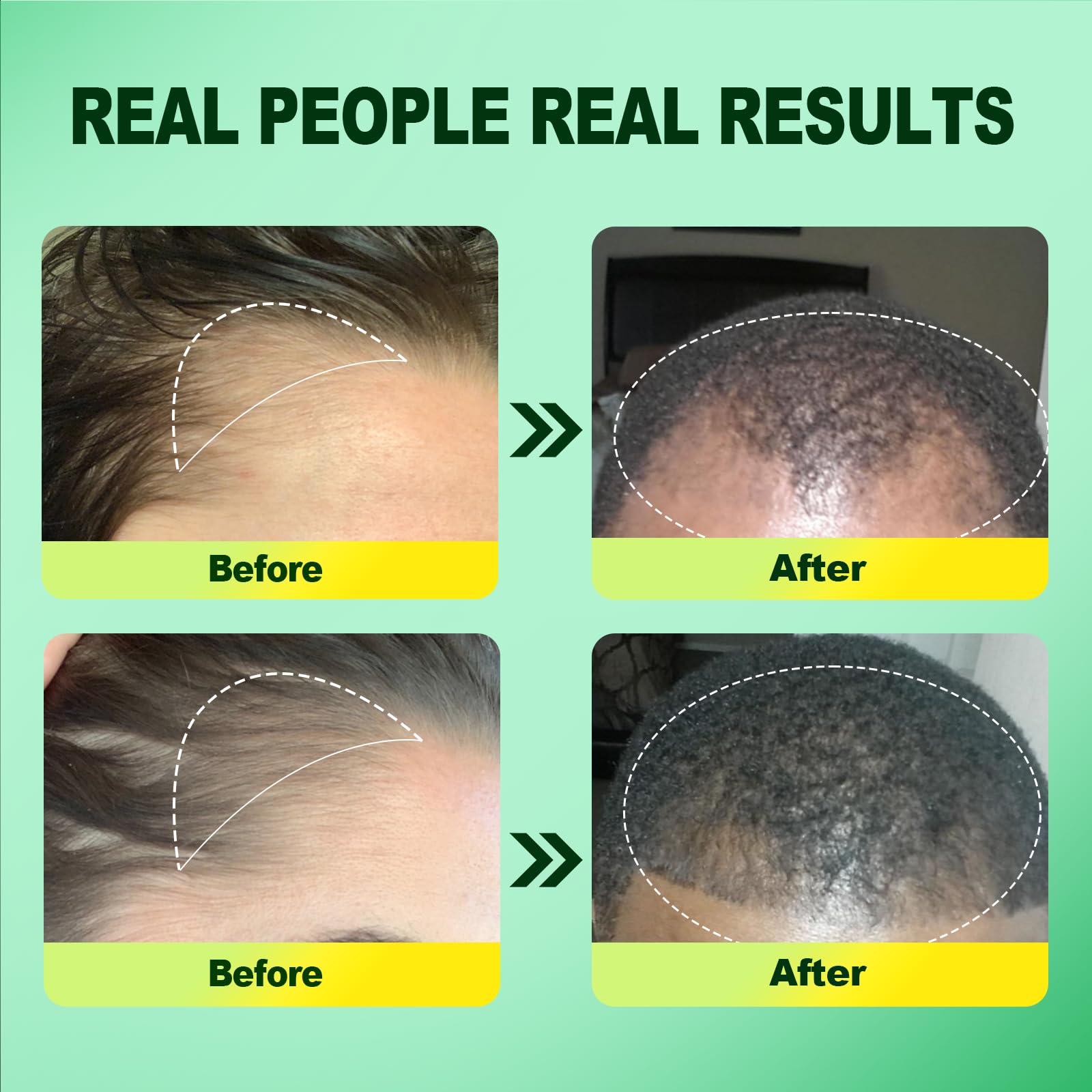 Pipuxi Minoxidil serum applicator for precise, mess-free application